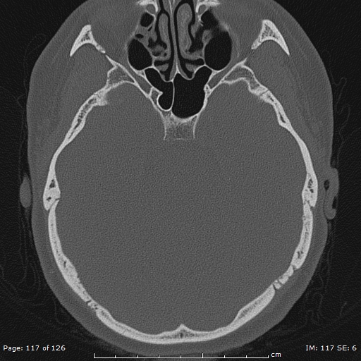 Cholesteatoma - external auditory canal (Radiopaedia 88452-105096 Axial bone window 80).jpg