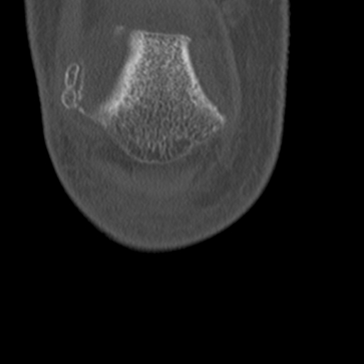 Chondrocalcinosis (Radiopaedia 16275-15955 Coronal bone window 9).jpg