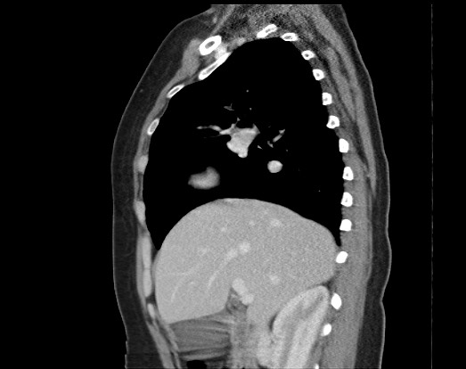 Chondrosarcoma - chest wall (Radiopaedia 65192-74199 B 39).jpg