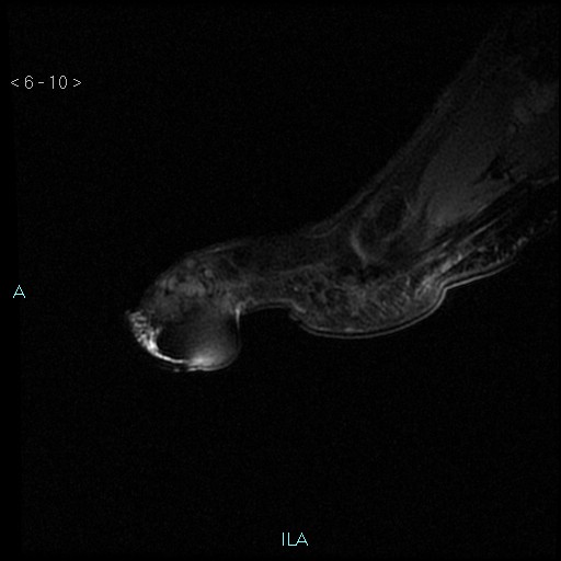 File:Chondrosarcoma - phalanx (Radiopaedia 69047-78813 Sagittal PD fat sat 10).jpg