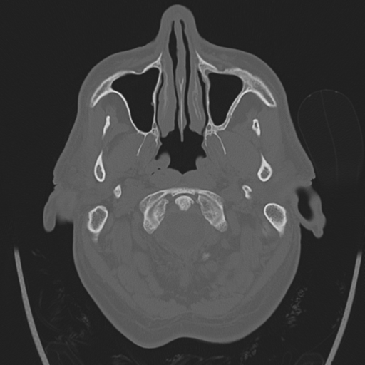 Chondrosarcoma of skull base- grade II (Radiopaedia 40948-43653 Axial bone window 1).png