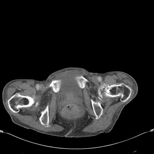 Chondrosarcoma of the spine (Radiopaedia 49871-55143 A 64).jpg