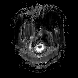 File:Chordoid glioma of third ventricle (Radiopaedia 91612-109340 Axial ADC 2).jpg