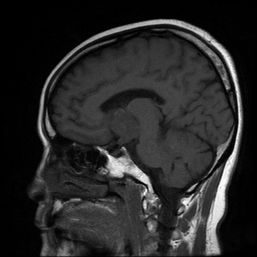 File:Chordoid glioma of third ventricle (Radiopaedia 91612-109340 Sagittal T1 15).jpg