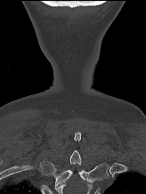 Chordoma (C4 vertebra) (Radiopaedia 47561-52188 Coronal bone window 61).png