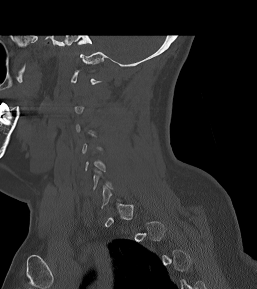 File:Chordoma (C4 vertebra) (Radiopaedia 47561-52188 Sagittal bone window 22).png