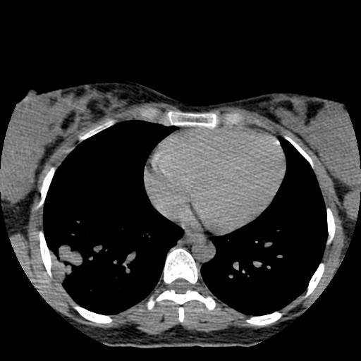 Choriocarcinoma of ovary with cerebral and pulmonary metastases (Radiopaedia 25983-26119 Axial non-contrast 6).jpg