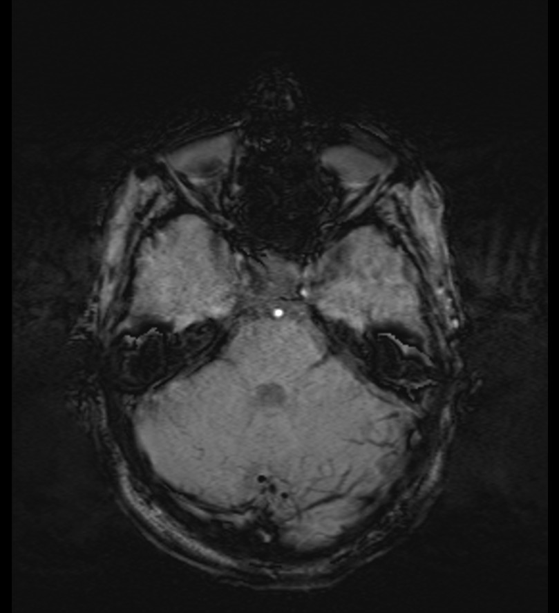 Choroid plexus xanthogranuloma (Radiopaedia 91271-108875 Axial SWI 19).jpg