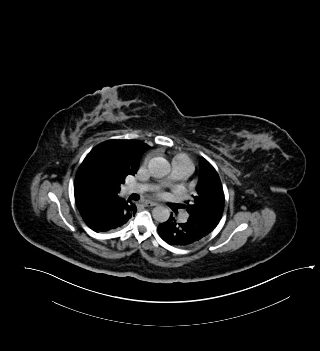Chromophobe renal cell carcinoma (Radiopaedia 84239-99519 E 2).jpg