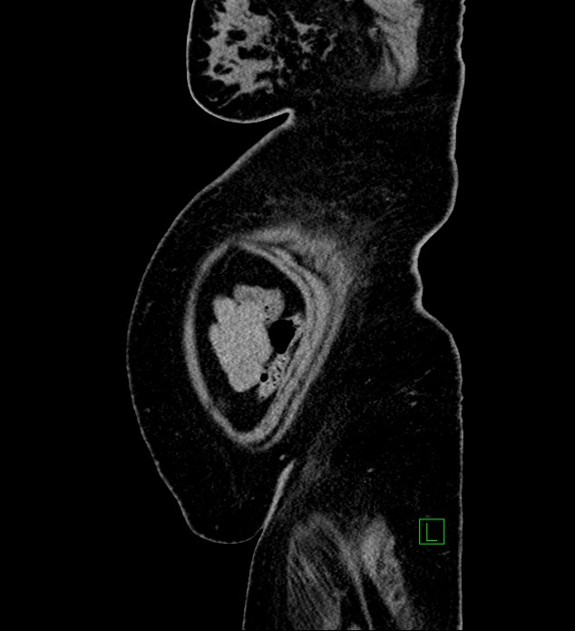 Chromophobe renal cell carcinoma (Radiopaedia 84239-99519 G 9).jpg