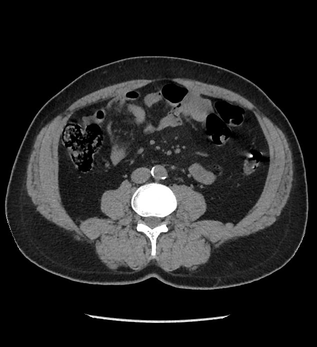 Chromophobe renal cell carcinoma (Radiopaedia 86879-103083 Axial non-contrast 62).jpg
