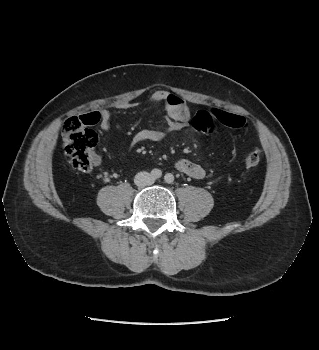 Chromophobe renal cell carcinoma (Radiopaedia 86879-103083 D 90).jpg
