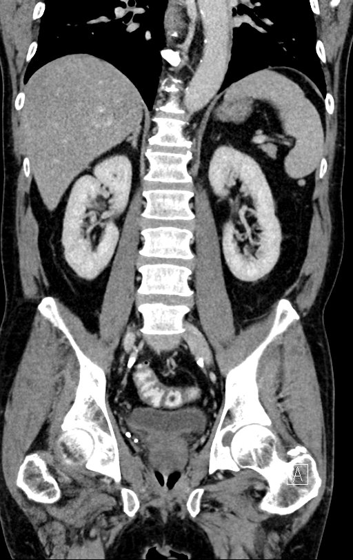 Chronic appendicitis complicated by appendicular abscess, pylephlebitis and liver abscess (Radiopaedia 54483-60700 C 52).jpg