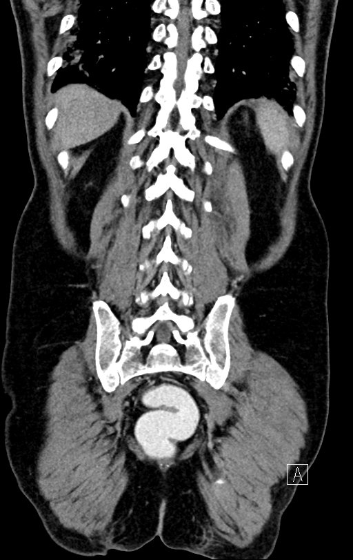 Chronic appendicitis complicated by appendicular abscess, pylephlebitis and liver abscess (Radiopaedia 54483-60700 C 68).jpg