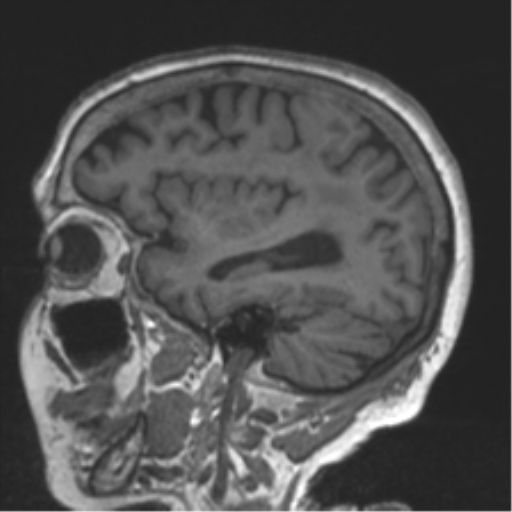 Chronic hypertensive encephalopathy (Radiopaedia 39993-42482 Sagittal T1 30).png