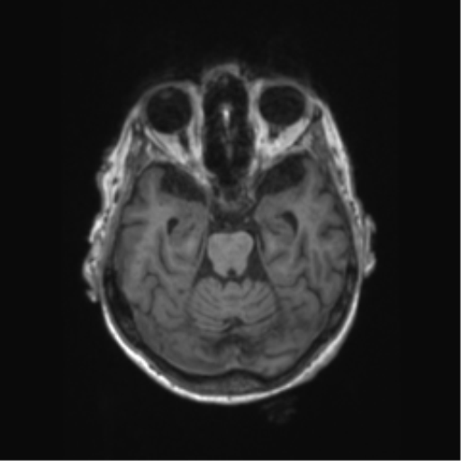 File:Chronic hypertensive encephalopathy (Radiopaedia 72844-83495 Axial T1 48).png