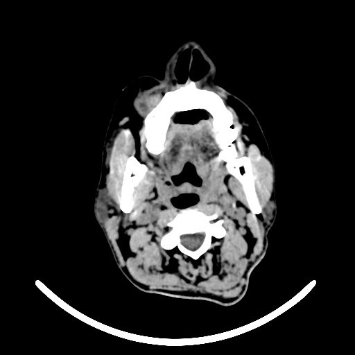 File:Chronic invasive fungal sinusitis with intraorbital and intracranial extension (Radiopaedia 56387-63046 Axial non-contrast 13).jpg