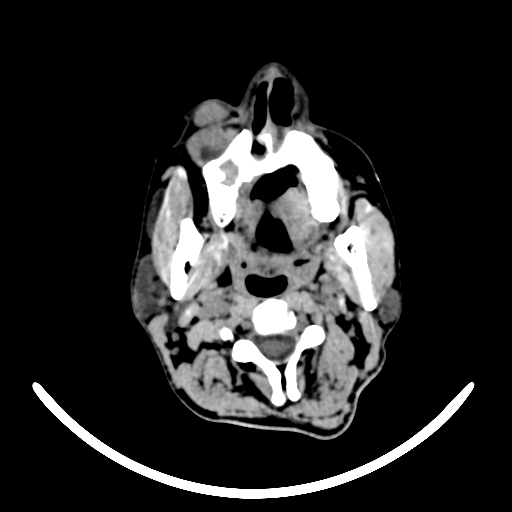 File:Chronic invasive fungal sinusitis with intraorbital and intracranial extension (Radiopaedia 56387-63046 Axial non-contrast 26).jpg