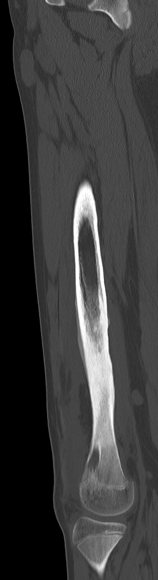 Chronic ostemyelitis of the femur with long sinus tract (Radiopaedia 74947-85982 Sagittal bone window 46).jpg