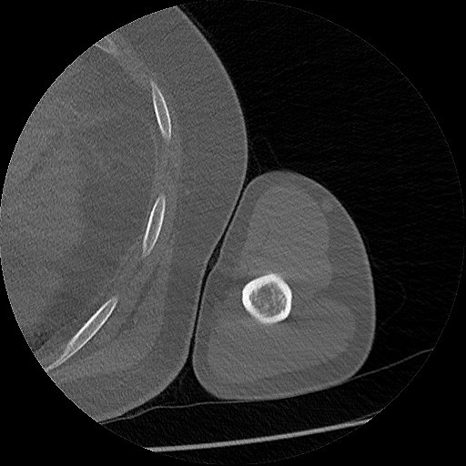 File:Chronic osteomyelitis (Radiopaedia 67597-76998 Axial bone window 35).jpg