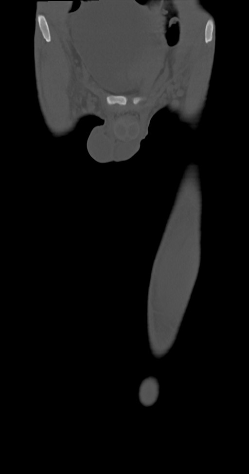 Chronic osteomyelitis (with sequestrum) (Radiopaedia 74813-85822 Coronal non-contrast 6).jpg