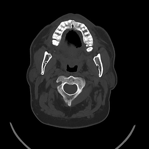 Chronic osteomyelitis - calvarial (severe) (Radiopaedia 69668-79616 Axial bone window 16).jpg