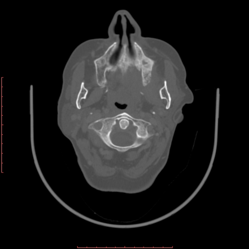 Chronic osteomyelitis - maxilla (Radiopaedia 23783-23927 Axial bone window 86).jpg
