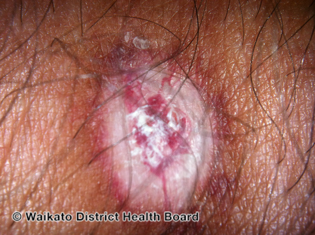 File:Chronic radiation dermatitis (DermNet NZ reactions-w-radiation-dermatitis5).jpg