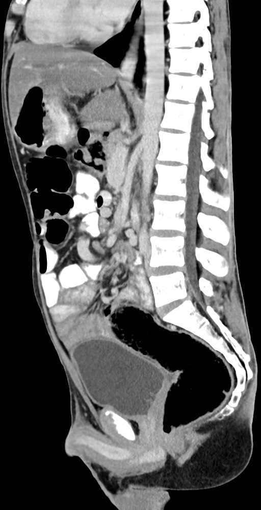 Chronic small bowel volvulus (Radiopaedia 75224-86322 C 73).jpg