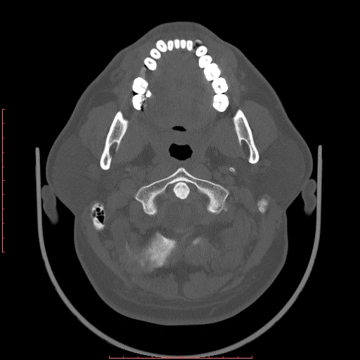 Chronic submandibular sialolithiasis (Radiopaedia 69817-79814 Axial bone window 26).jpg