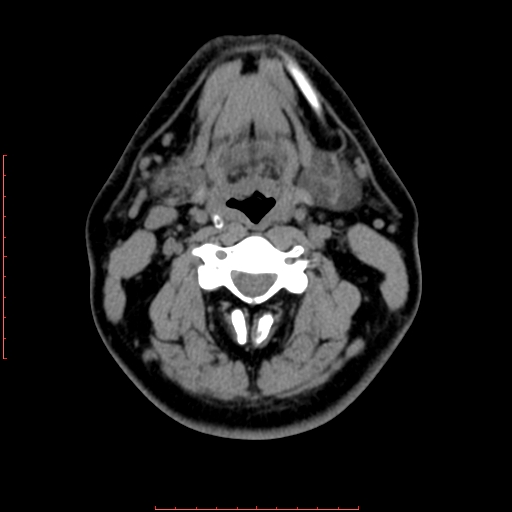 Chronic submandibular sialolithiasis (Radiopaedia 69817-79814 Axial non-contrast 120).jpg