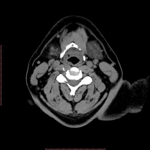 File:Chronic submandibular sialolithiasis (Radiopaedia 69817-79814 Axial non-contrast 139).jpg