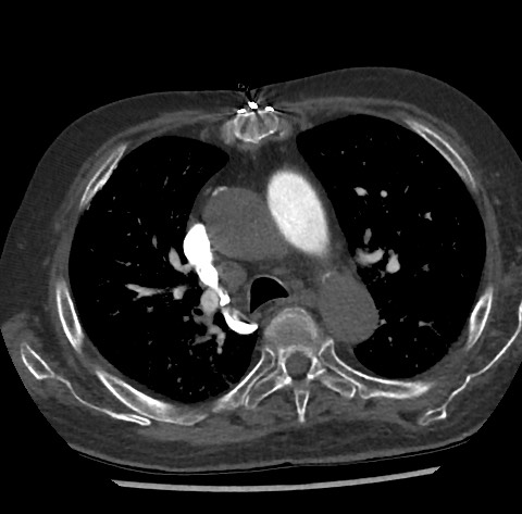 Chronic thromboembolic pulmonary disease (Radiopaedia 90694-108119 Axial C+ CTPA 36).jpg