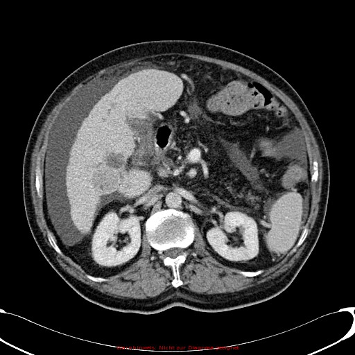 File:Cirrhosis and hepatocellular carcinoma in the setting of hemochromatosis (Radiopaedia 75394-86595 B 36).jpg