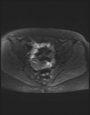 File:Class II Mullerian duct anomaly- unicornuate uterus with rudimentary horn and non-communicating cavity (Radiopaedia 39441-41755 Axial DWI 14).jpg