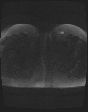 File:Class II Mullerian duct anomaly- unicornuate uterus with rudimentary horn and non-communicating cavity (Radiopaedia 39441-41755 Axial DWI 96).jpg