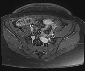 File:Class II Mullerian duct anomaly- unicornuate uterus with rudimentary horn and non-communicating cavity (Radiopaedia 39441-41755 Axial T1 fat sat 19).jpg