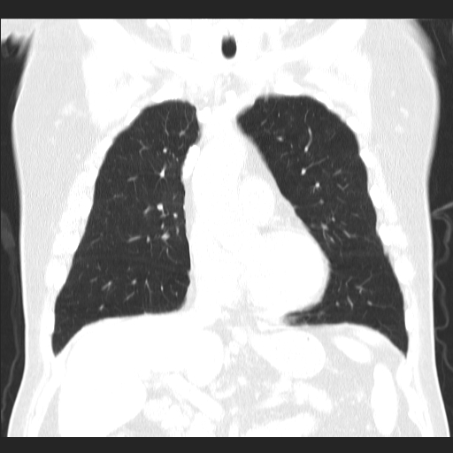File:Classic complicated silicosis (Radiopaedia 49720-54961 Coronal lung window 22).jpg