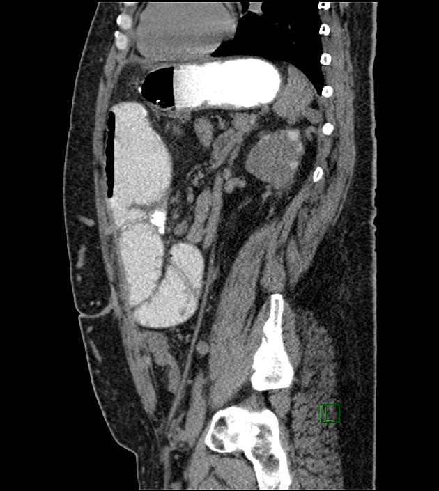 Closed-loop small bowel obstruction-internal hernia (Radiopaedia 78439-91096 C 57).jpg