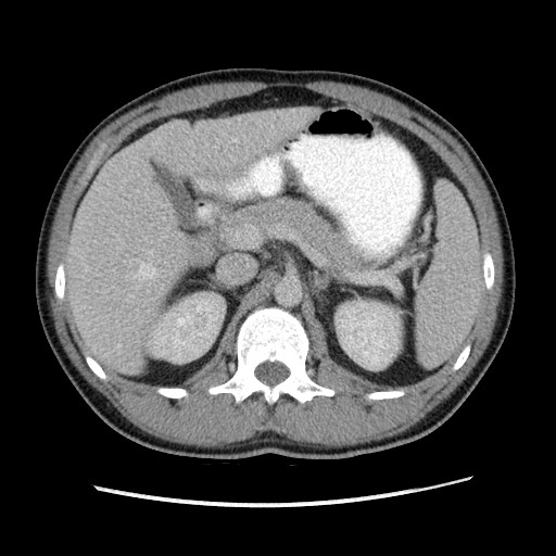 File:Closed-loop small bowel obstruction (Radiopaedia 73713-84509 A 54).jpg