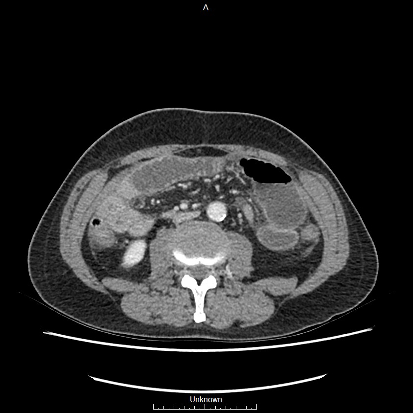 Closed loop bowel obstruction and ischemia (Radiopaedia 86959-103180 A 41).jpg