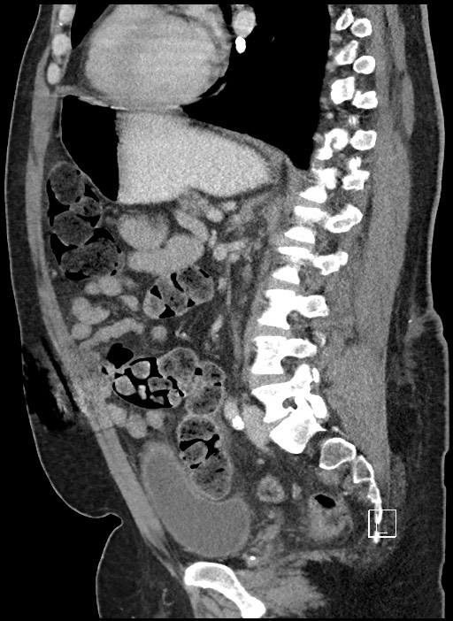Closed loop obstruction - internal hernia into nephrectomy bed (Radiopaedia 59867-67320 C 36).jpg