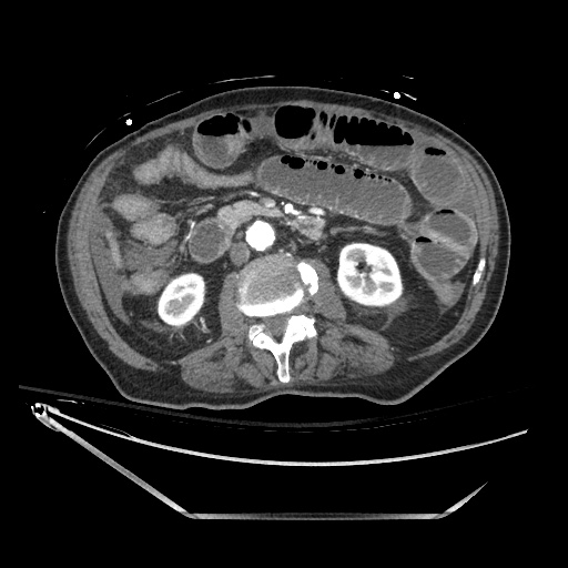 Closed loop obstruction due to adhesive band, resulting in small bowel ischemia and resection (Radiopaedia 83835-99023 B 70).jpg