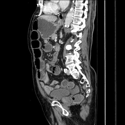Closed loop obstruction due to adhesive band, resulting in small bowel ischemia and resection (Radiopaedia 83835-99023 F 107).jpg
