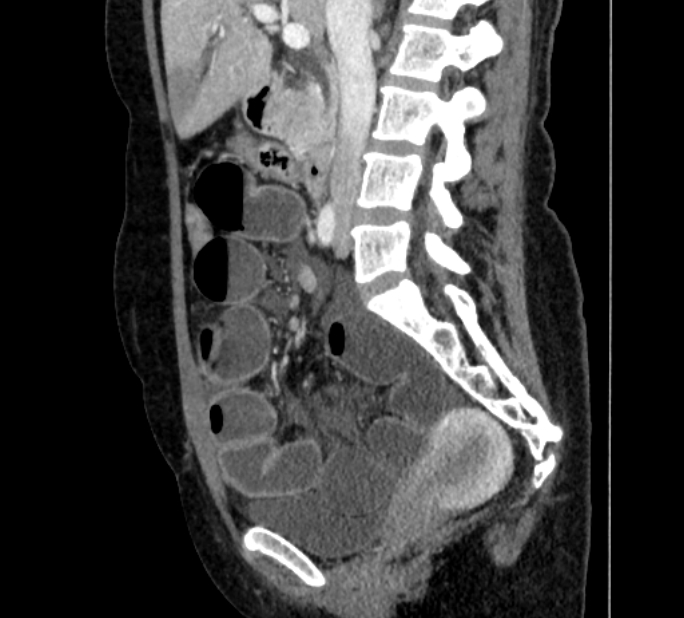 Closed loop small bowel obstruction (Radiopaedia 71211-81508 C 64).jpg
