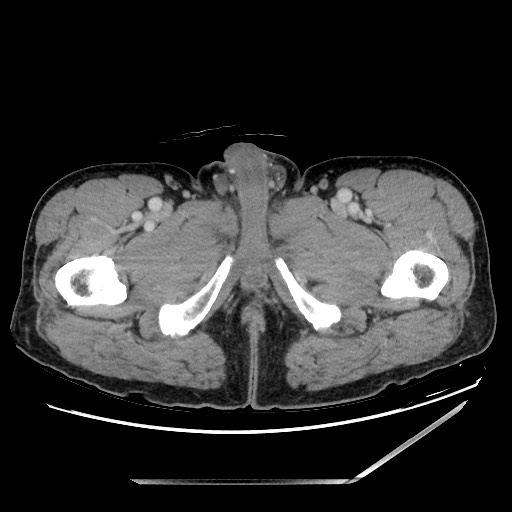 Closed loop small bowel obstruction - omental adhesion causing "internal hernia" (Radiopaedia 85129-100682 A 188).jpg