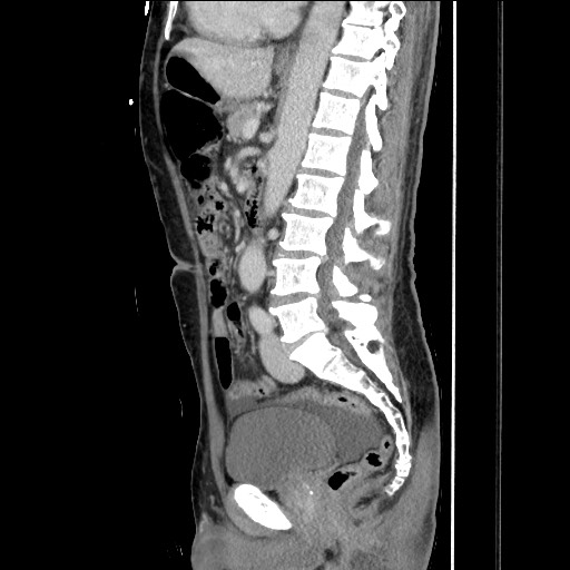 Closed loop small bowel obstruction - omental adhesion causing "internal hernia" (Radiopaedia 85129-100682 C 98).jpg