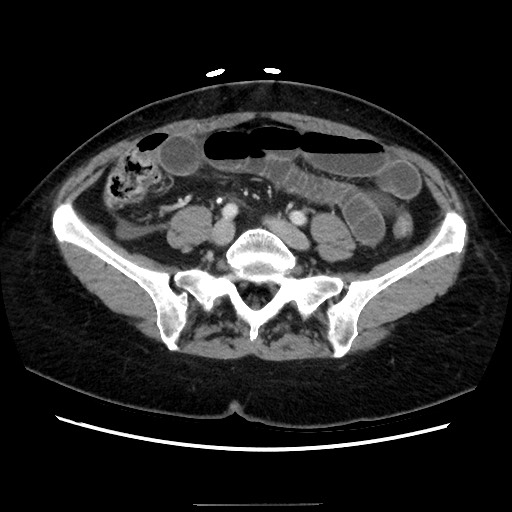 Closed loop small bowel obstruction due to adhesive bands - early and late images (Radiopaedia 83830-99015 A 114).jpg