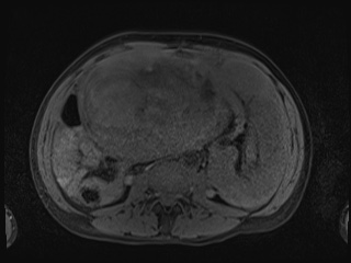 Closed loop small bowel obstruction in pregnancy (MRI) (Radiopaedia 87637-104031 Axial T1 fat sat 70).jpg