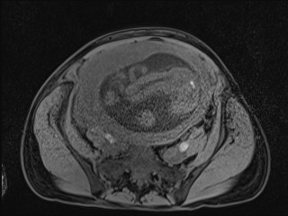 Closed loop small bowel obstruction in pregnancy (MRI) (Radiopaedia 87637-104031 F 35).jpg